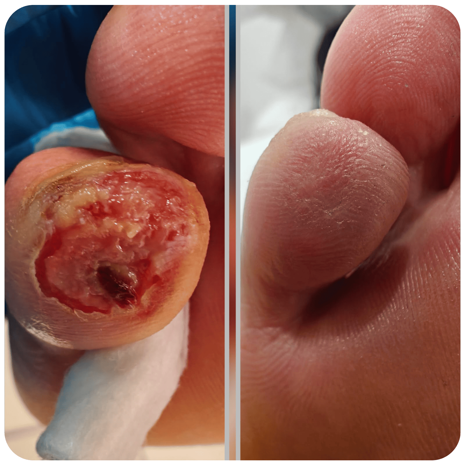 Picior diabetic