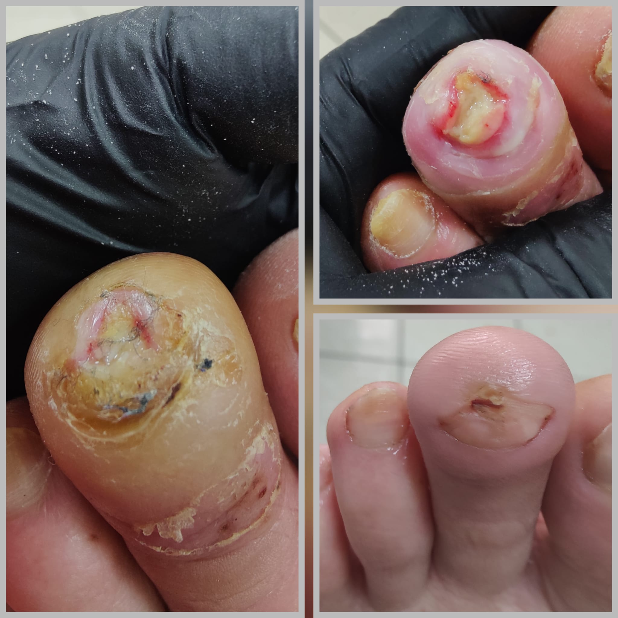 Piciorul diabetic
